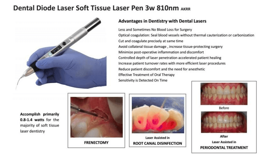 Laser tesuturi moi A2RR - MagStom