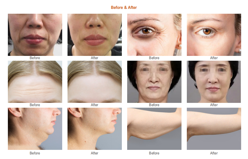 Aparatul 10D HIFU