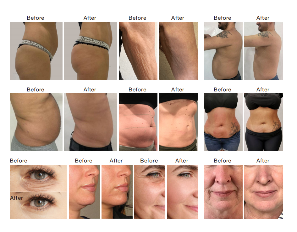 V-Shape Platinum – Aparat profesional 5-în-1 pentru remodelare corporală și anti-aging